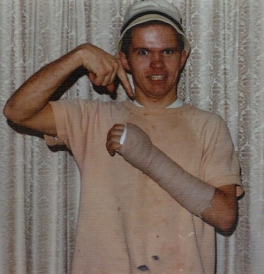 #526=Elliott's broken hand; Feb. 1974